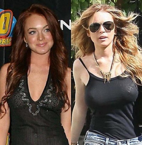 celebrities-before-and-after-plastic-surgery-images-00009